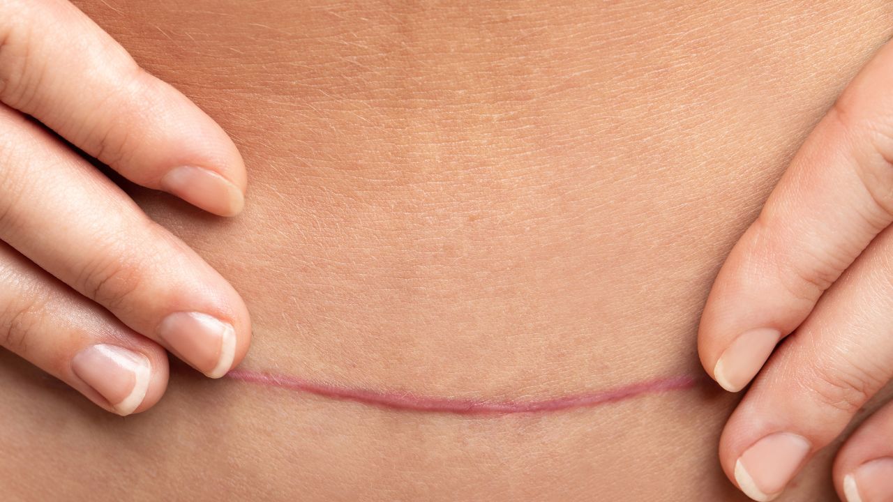 image of c-section scar